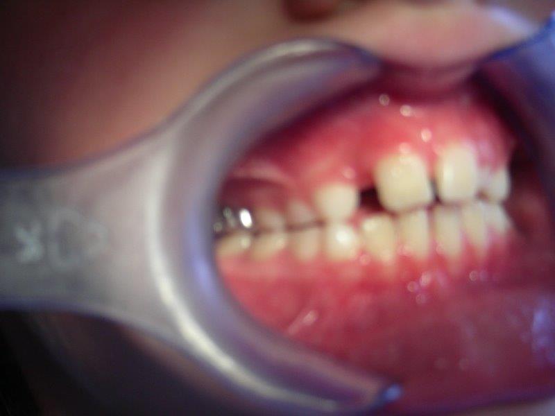 falta de espacio para el incisivo lateral