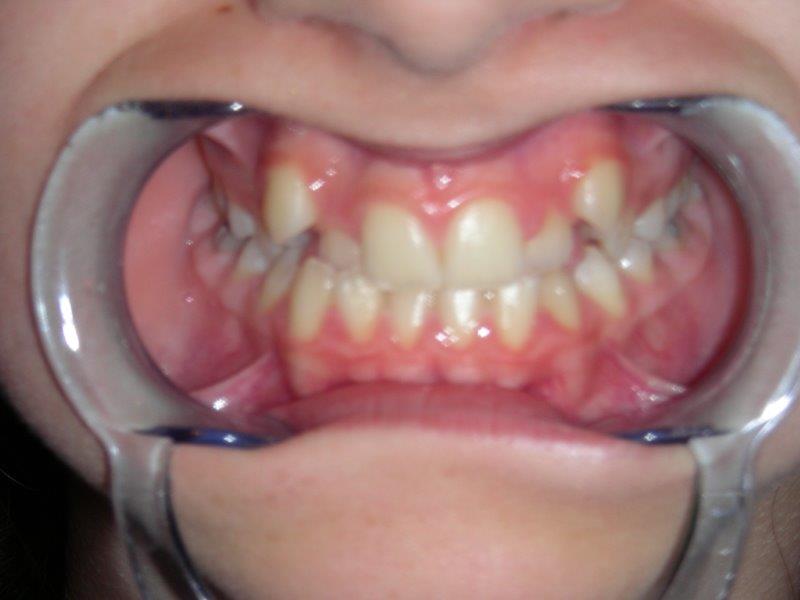 falta espacio colmillos