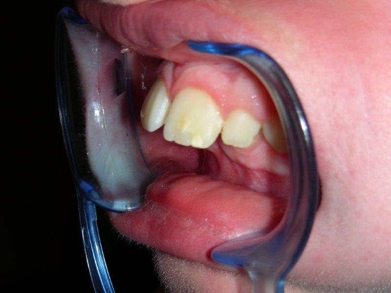 prominencia incisivos superiores